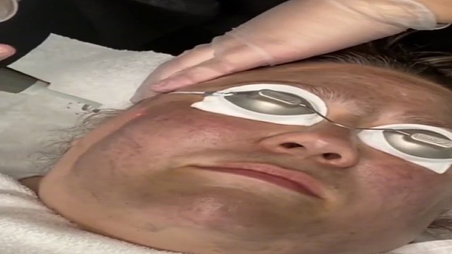 激光碳剥皮？看着就疼，不过太解压了.