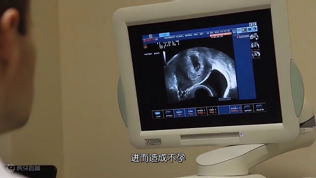 临汾仁爱生殖医院：子G内膜异位症可引起不孕