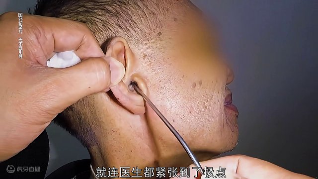 大爷的耳朵里爬进一条带有白毛的不明生物，每天都感觉里面有东西乱钻。【纯属影视效果 请通过】#奇葩 #掏耳朵 #采耳