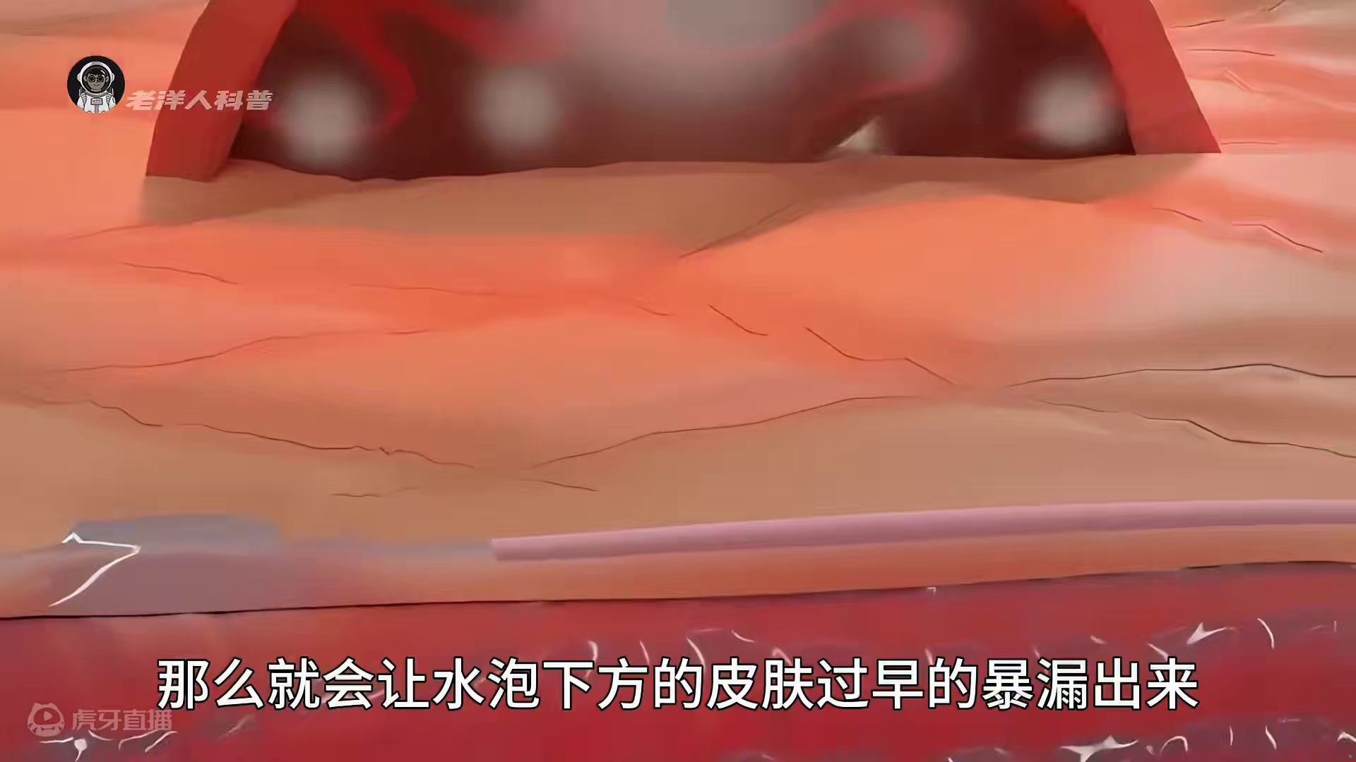 15. 手指伤口的小秘密，水泡到底应不应该戳破呢？