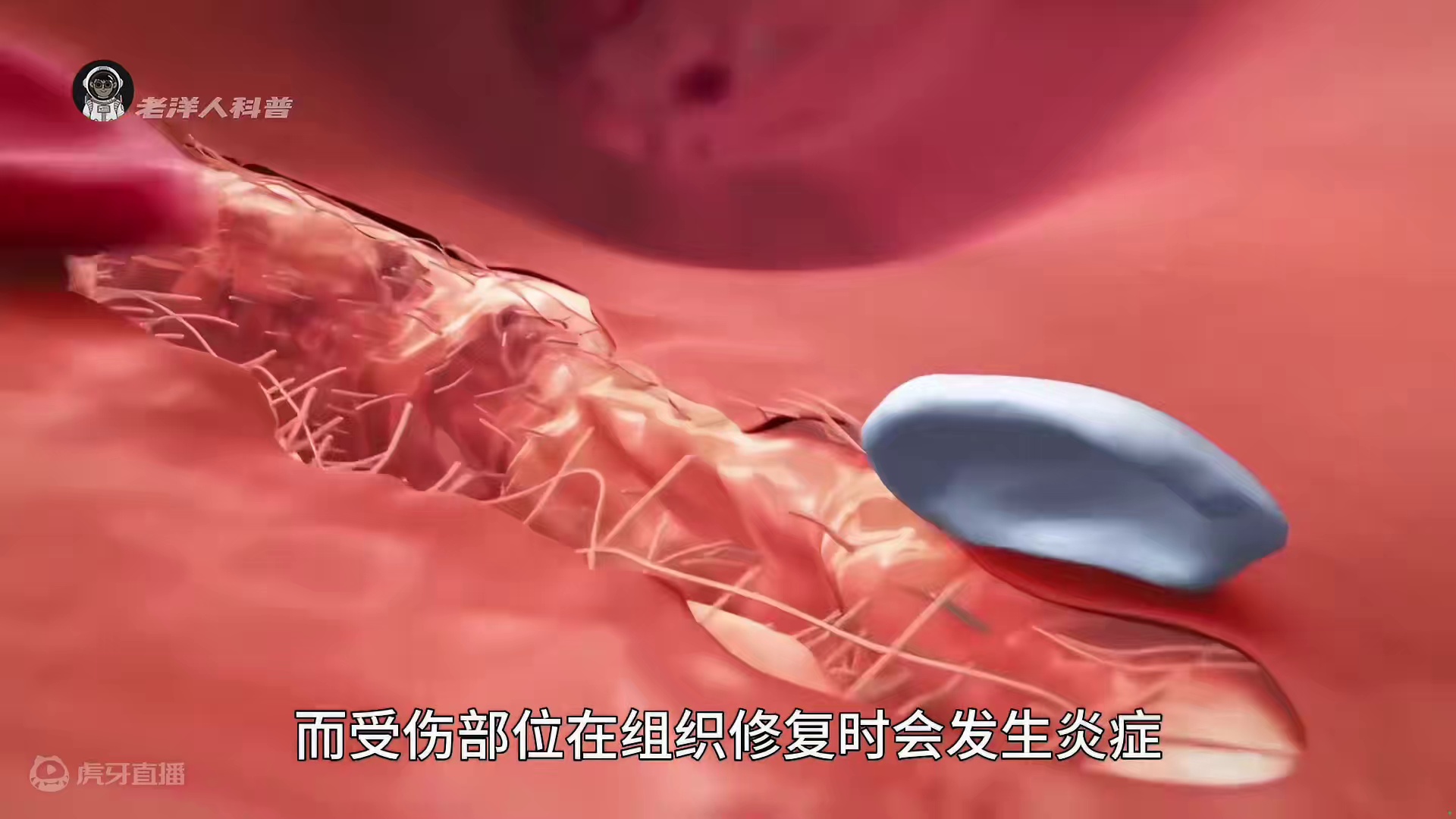 26. 人体受伤时伤口究竟怎样愈合的？看完后一目了然。