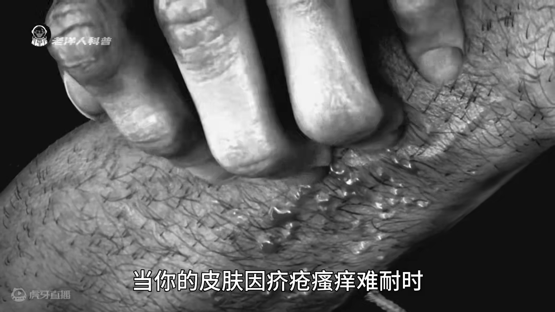 3. 皮肤上的小秘密，疥疮到底是如何形成的？