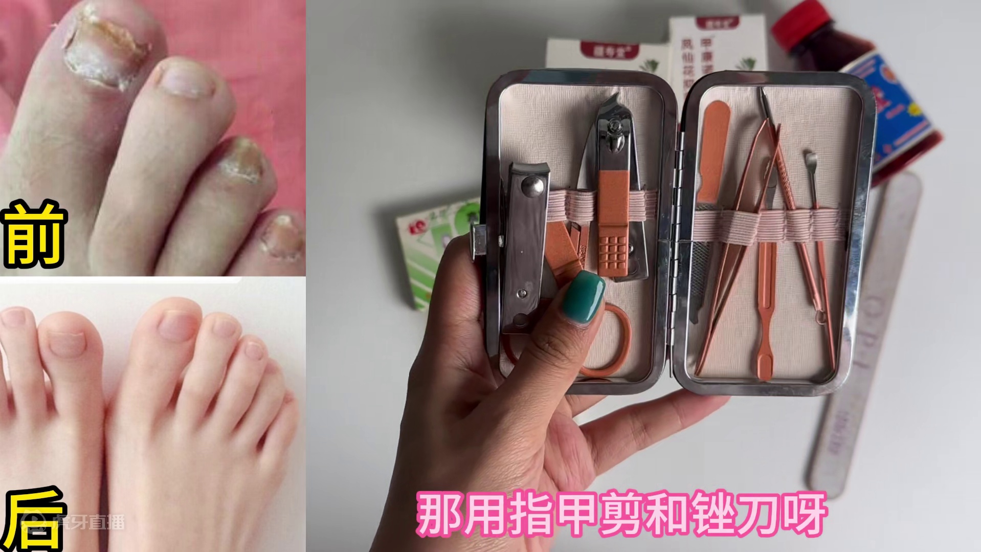 灰指甲详细治疗攻略来袭！速速扩散！简单几步效果胜10瓶特效药！