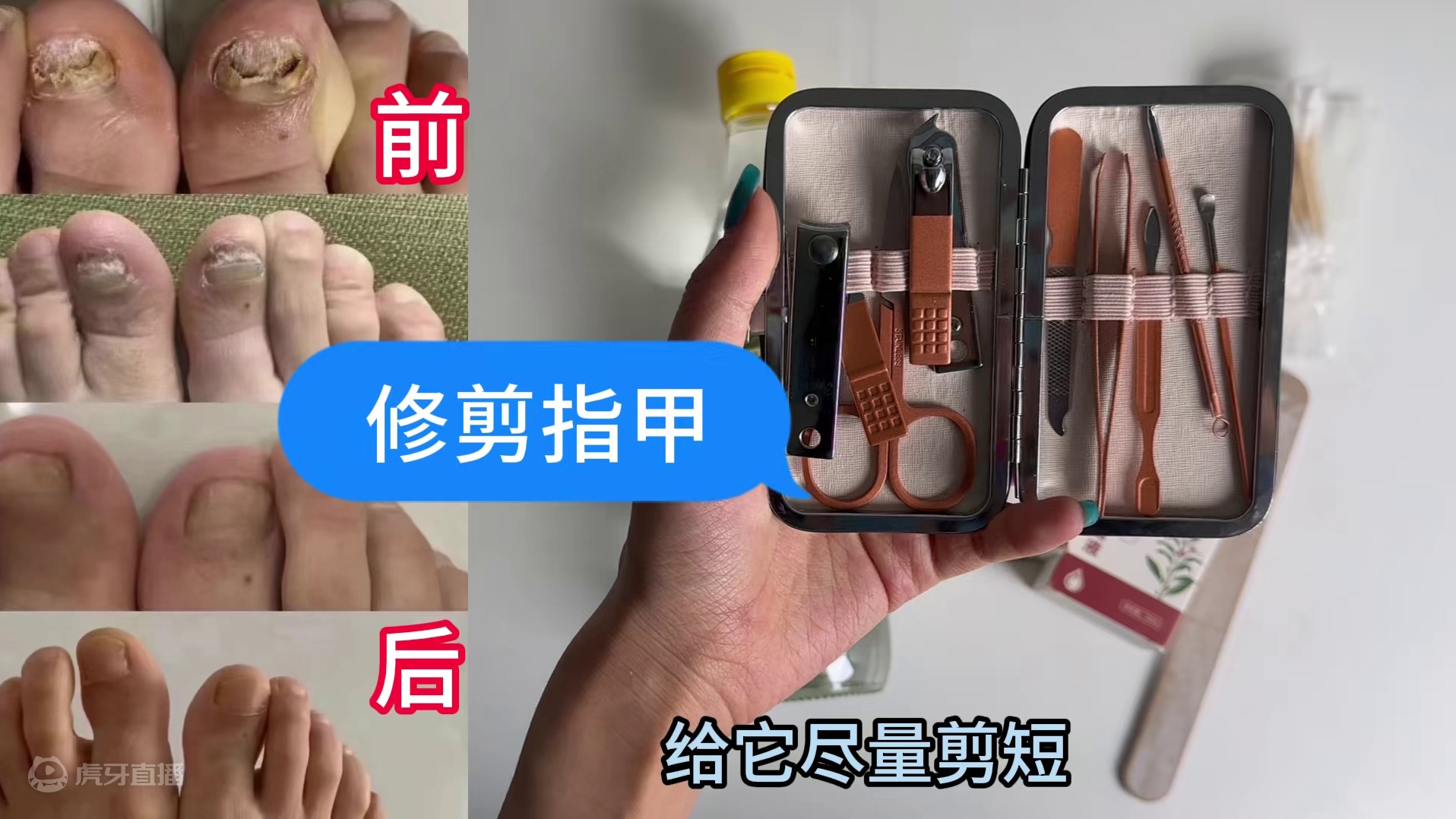 灰指甲顽固太难治？康复者：找对方法，坏甲秒变光滑新甲！