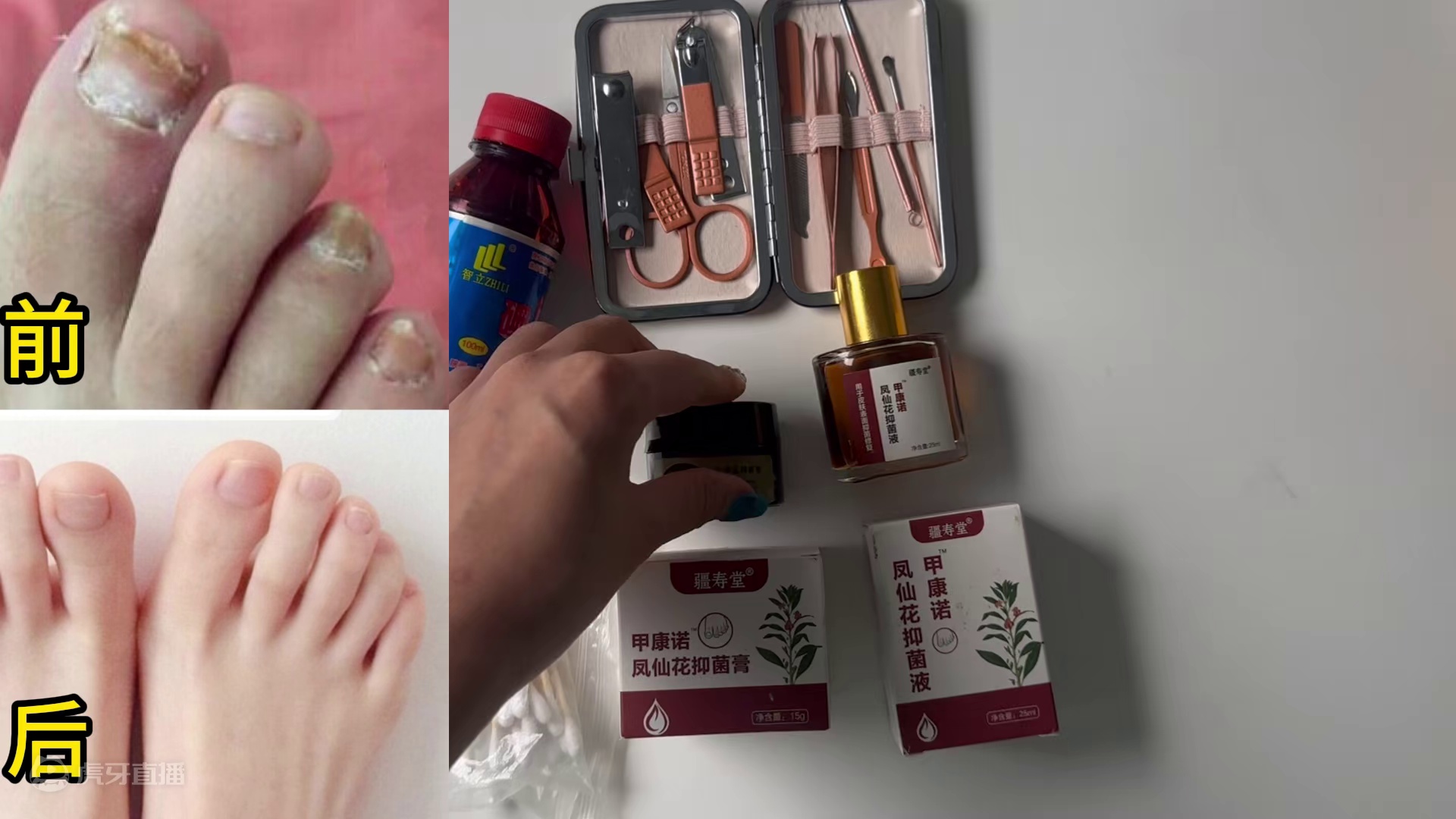 刷到就是赚到！康复者亲测有效的祛灰秘籍曝光！灰指甲说没就没！