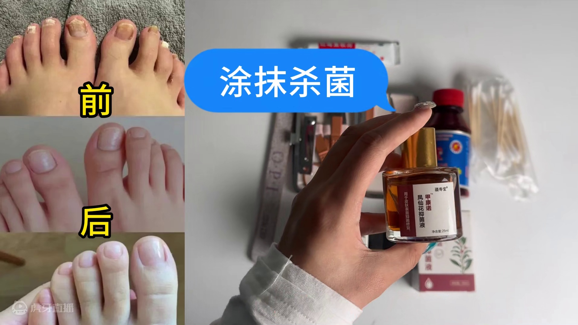 指甲受伤感染灰趾甲！治疗步骤详解！在家轻松摆脱不反复！