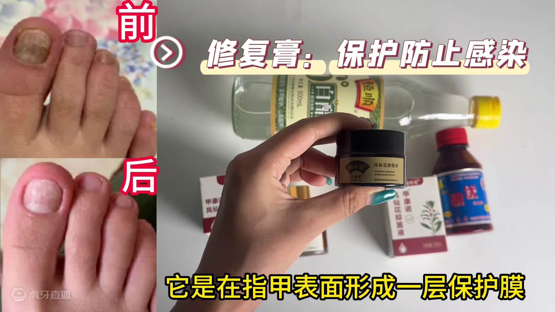 避雷！这些灰指甲祛灰方法可别再用了！真正有效的抑菌秘籍奉上！