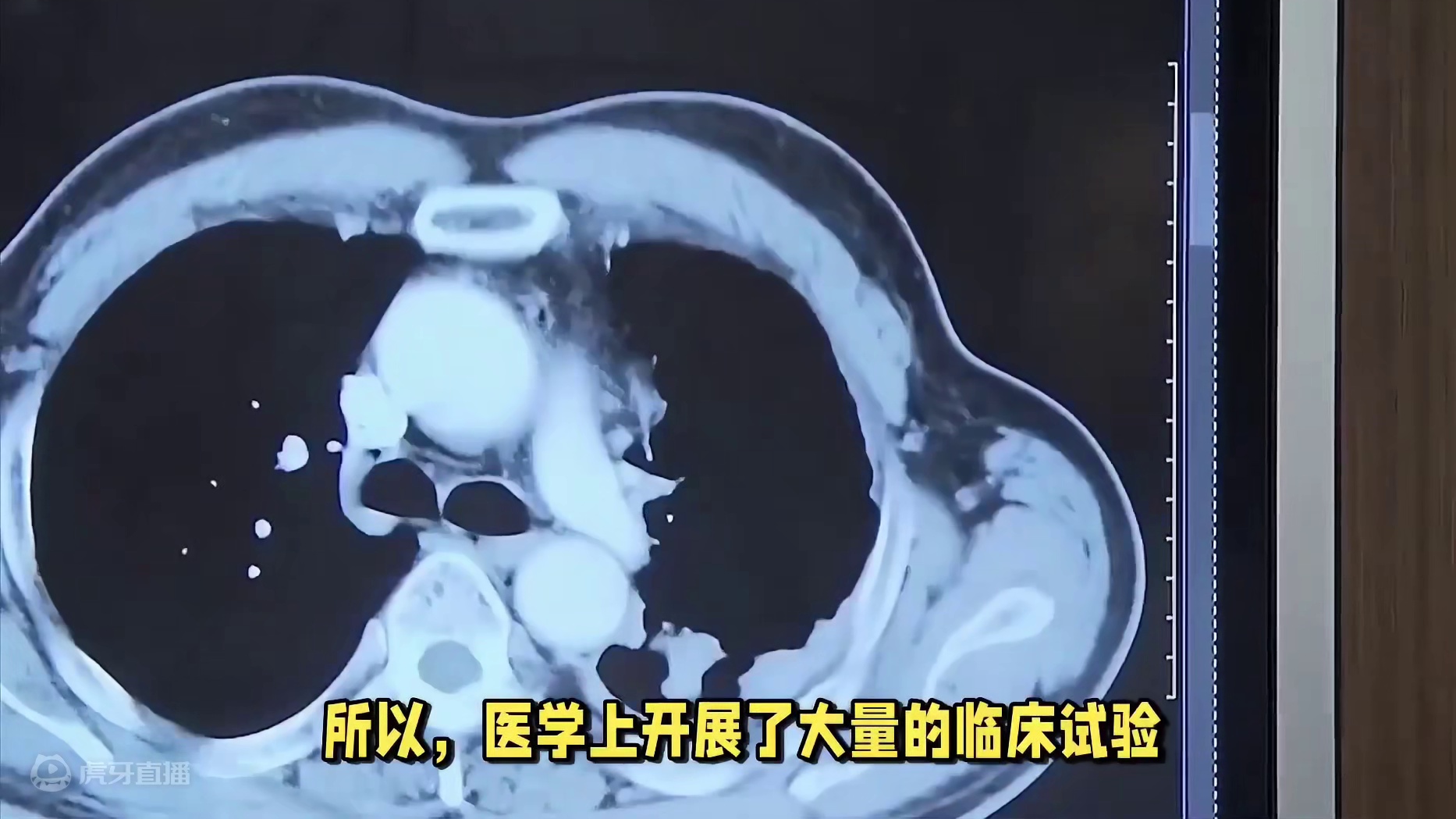 一个人最多可以做多少次化疗？