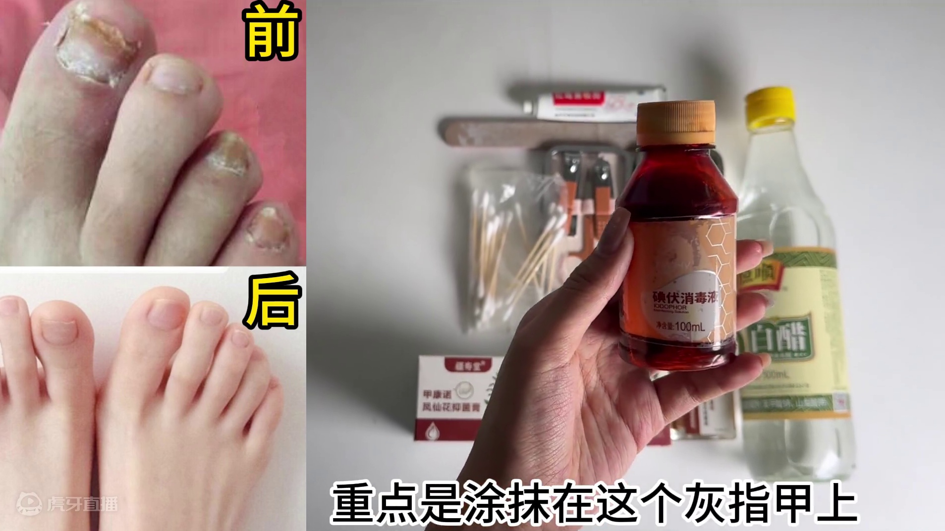 感染了灰指甲别拖！过来人手把手教你解决！学会立省大几千！