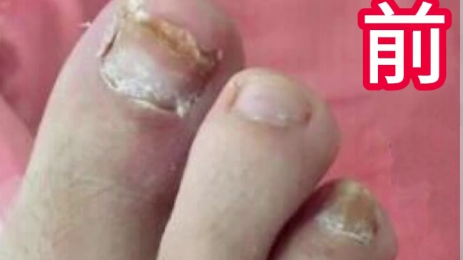 灰指甲真的很难治吗？康复者揭秘自用妙招！坏甲4步在家搞定！