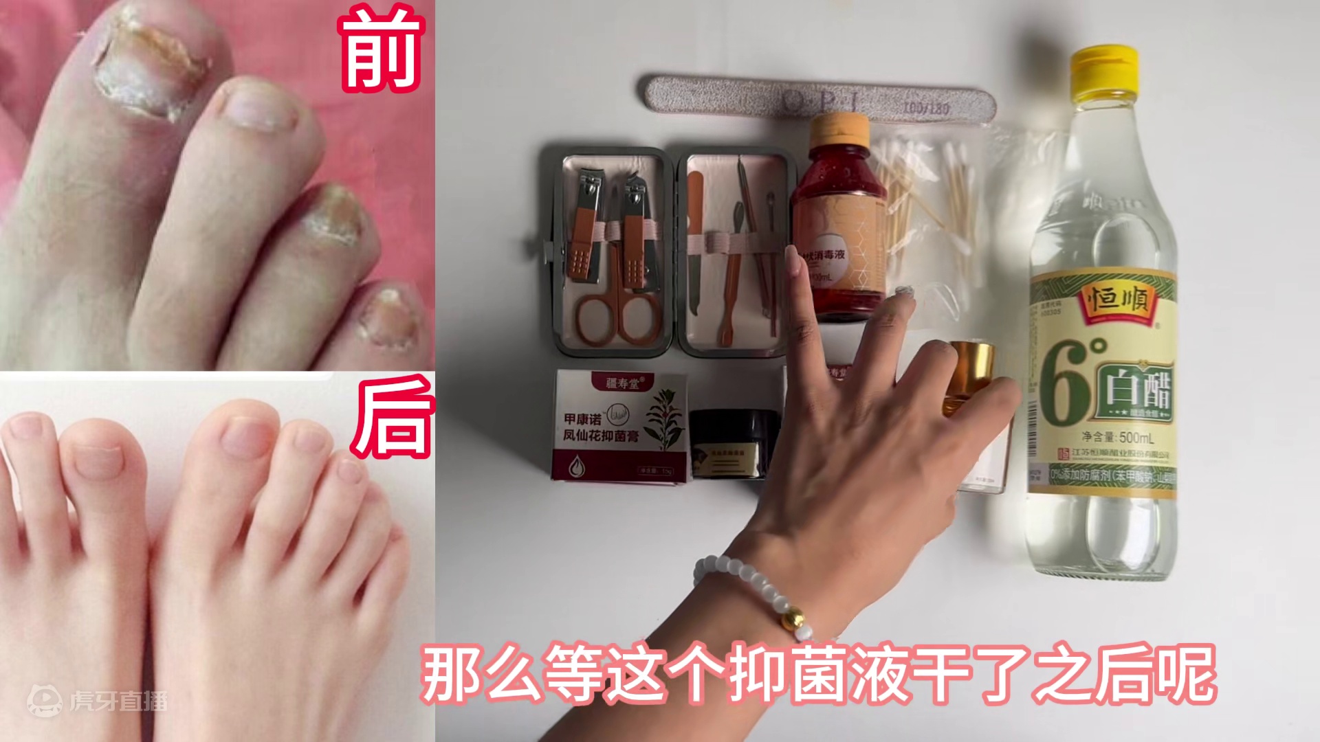 万万没想到！根治灰指甲竟然这么简单！后悔没早点知道！