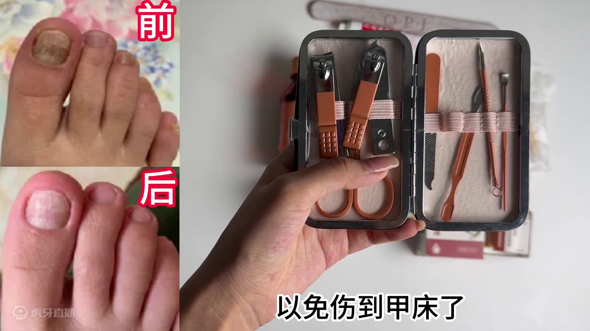 灰指甲如何根治不反复？过来人手把手教你！学会直省大几千！