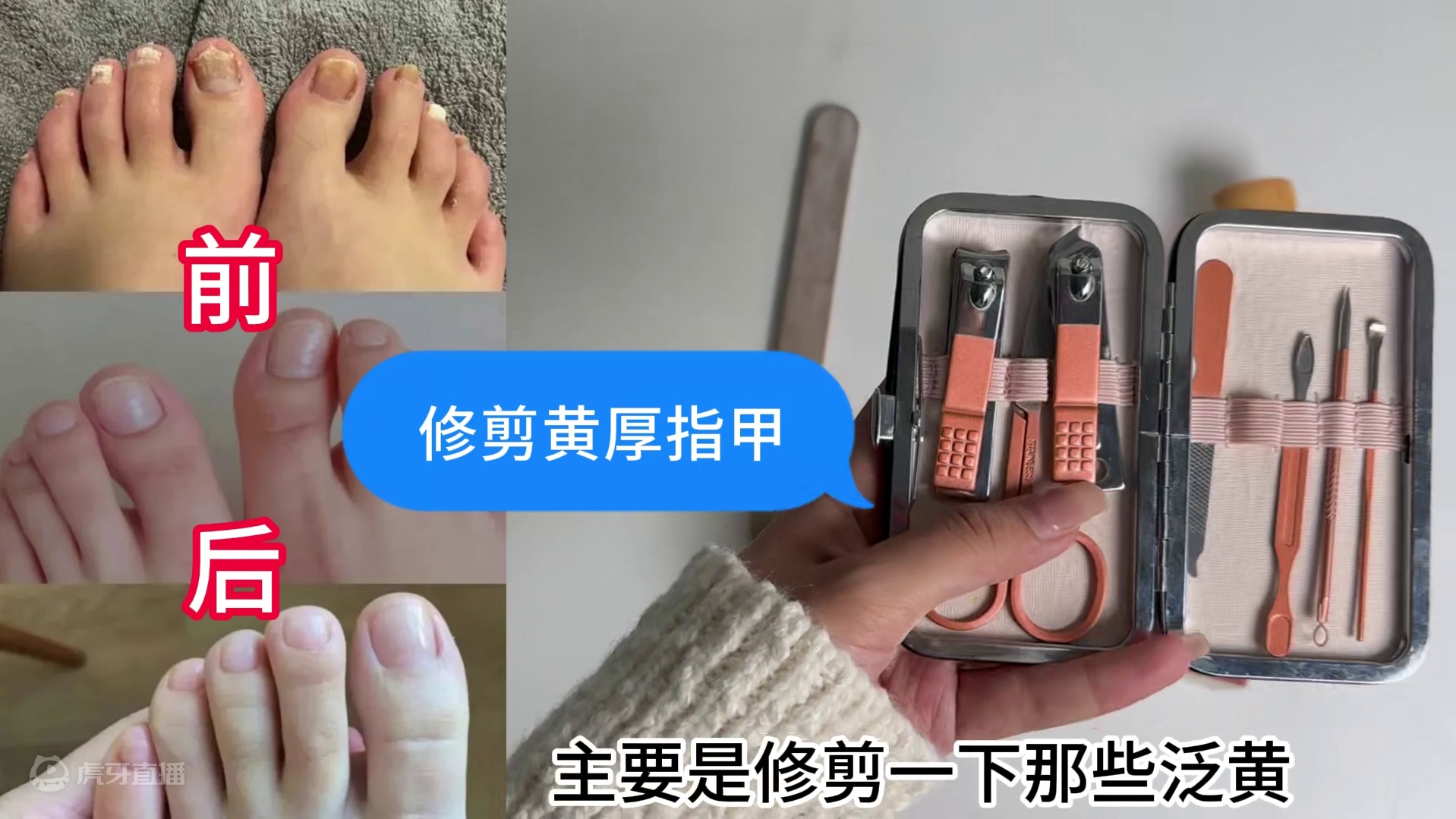 3个月摆脱多年顽固灰指甲！详细步骤首次公开！数万患者抢着用！