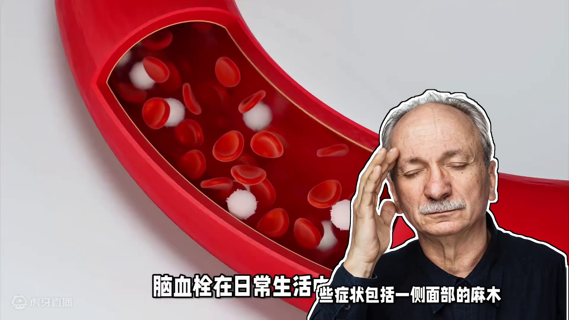 脑部血栓引发面部4种异常？你知道吗