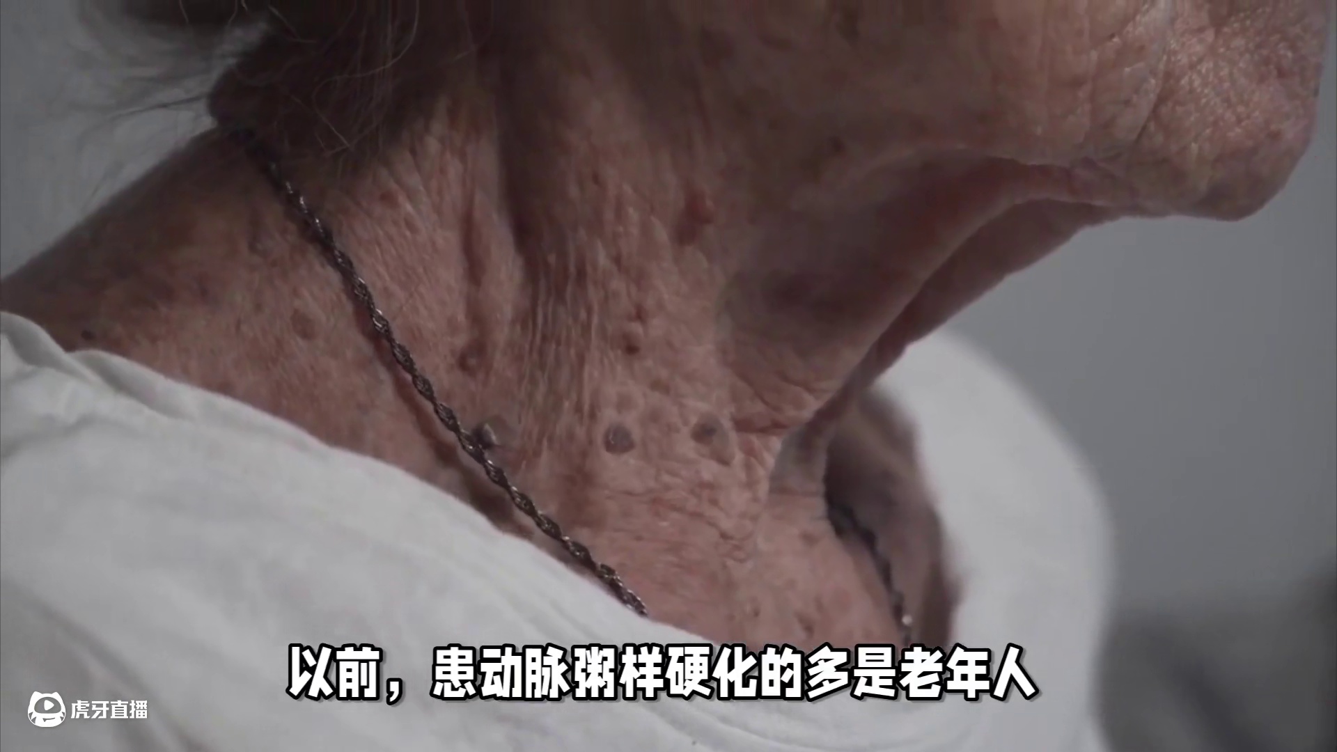 年轻人也有血管斑块？6个因素是罪魁祸首！