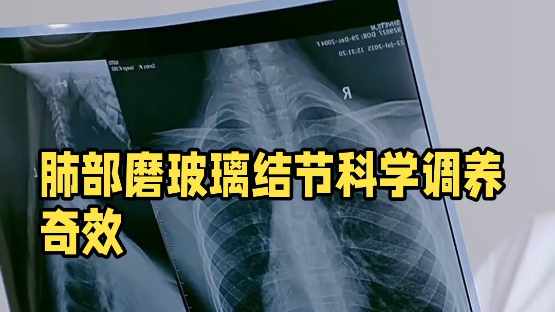 肺部磨玻璃结节再也不用担心！