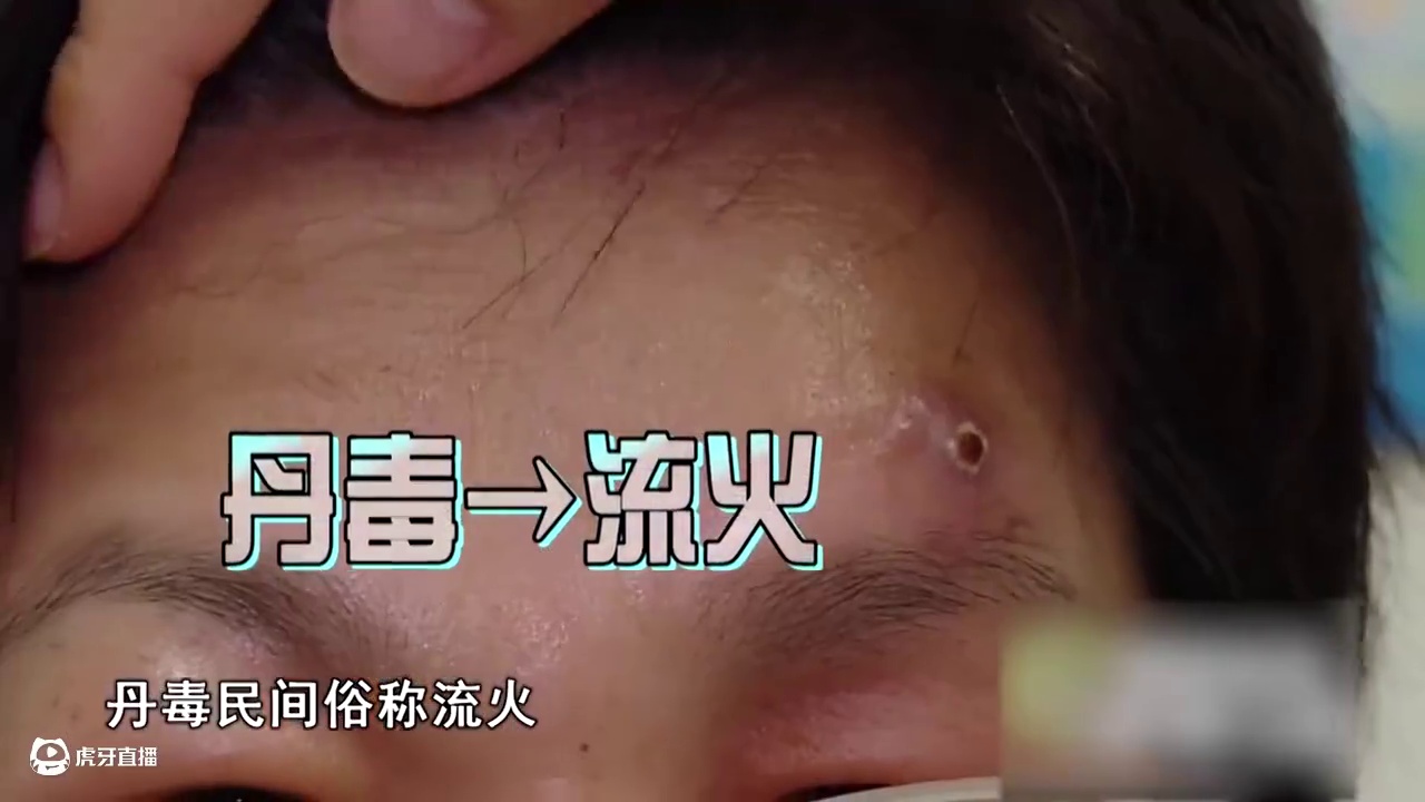 夏季小心染“毒”上身,哪些行为容易引起丹毒？ 