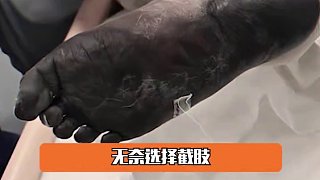 世界上最真實最無畏的超人，名為“爸爸媽媽” #截肢男孩13次手術(shù)后才第一次痛哭 #10歲男孩流感用一