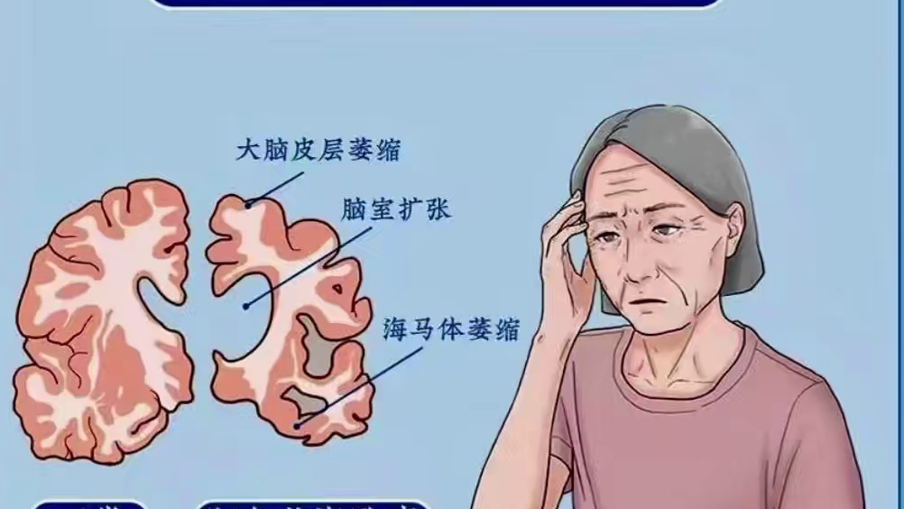 你知道阿尔兹海默症吗？