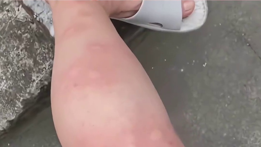 怪不得一只蚊子都能咬我半身包