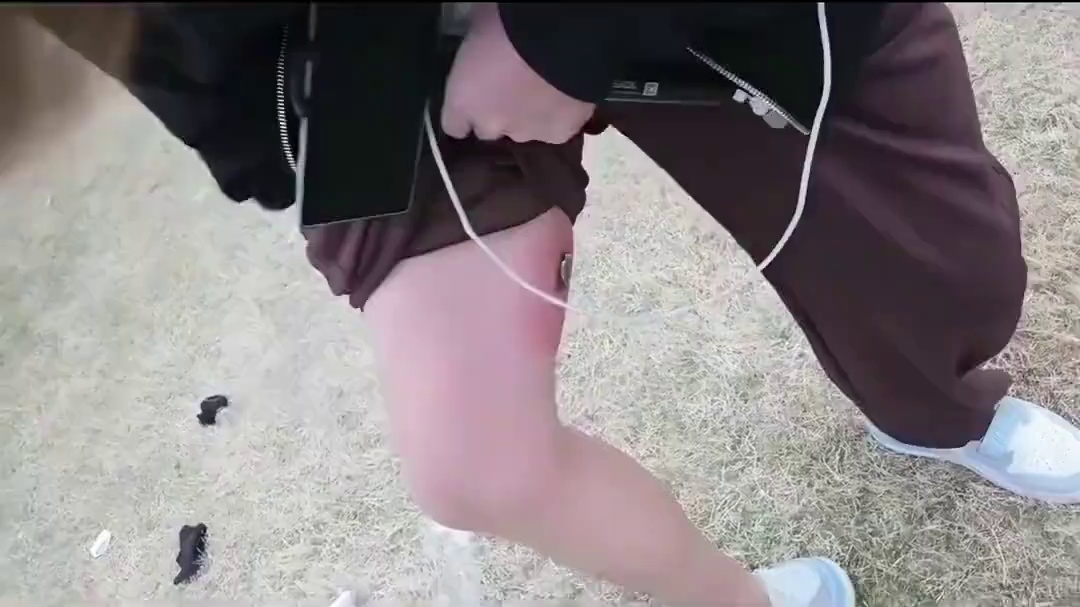 这已经不是火疖子了