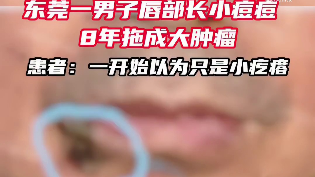 【】 东莞57岁的刘先生，右下唇长了个软软的小疙瘩，不疼不痒一直没在意，平时还总用手去抠、去挤。一拖