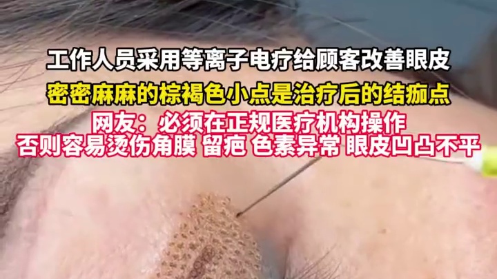 工作人员采用等离子电疗给顾客改善眼皮，密密麻麻的棕褐色小点是治疗后的结痂点1