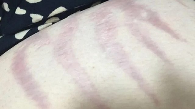 修复妊娠纹，抓住这个复黄金期！一个月纹路悄悄淡化消失！