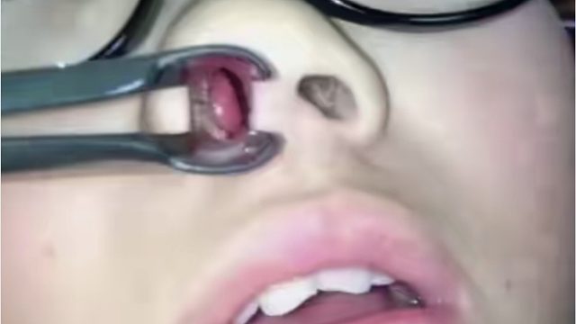 后悔没早看到！１个低成本方法解决孩子鼻炎！比吃药管用多了！