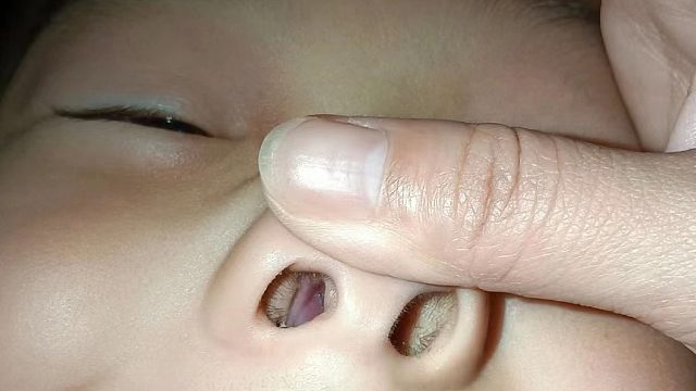 喷嚏狂大流涕不止？学会2个低成本方法孩子鼻炎在也不用受罪！