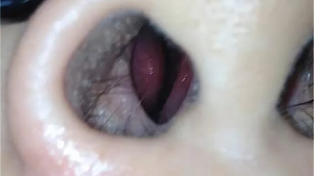 过敏性鼻炎鼻涕横流、喷嚏狂打咋办？记住这几点！鼻炎不再犯！