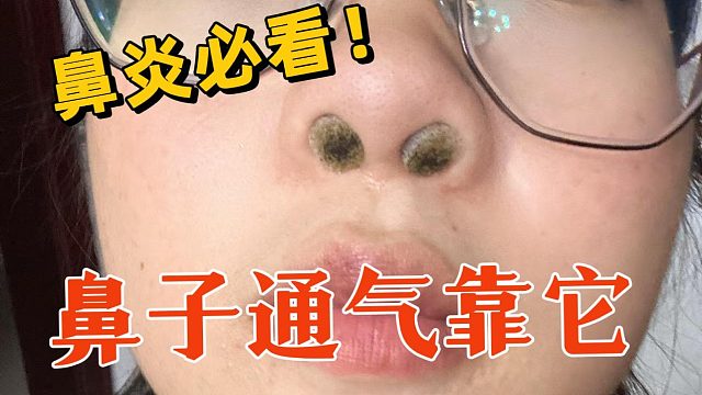 7年鼻炎经验曝光！喷嚏狂打眼泪直流3分钟立马搞定！不得不服！