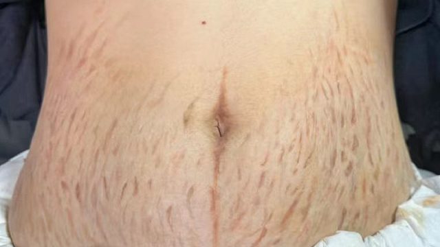 妊娠纹终于没了！全网爆火的淡纹妙招，真的还有人不知道吗？