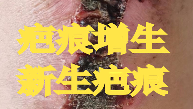 疤痕增生护理及新生疤痕护理，怎么选择合适的祛疤膏？