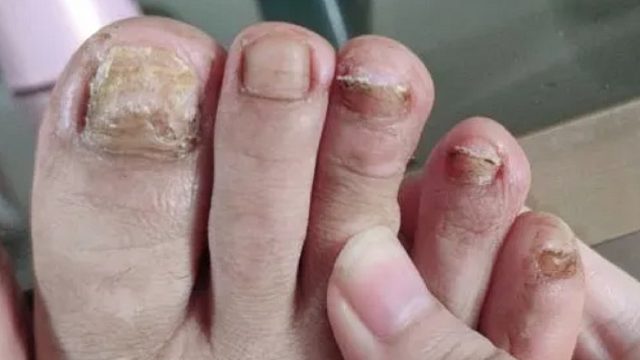 天热灰指甲真菌又活跃？！学会这招，在家轻松根治不复发！