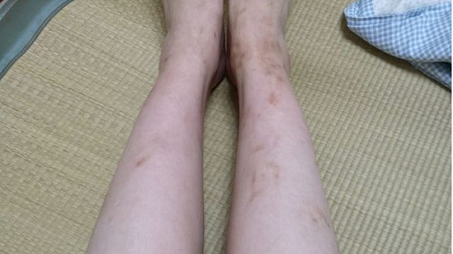 疤痕总是不找自来？别担心！跟着过来人分分钟拿下疤痕！