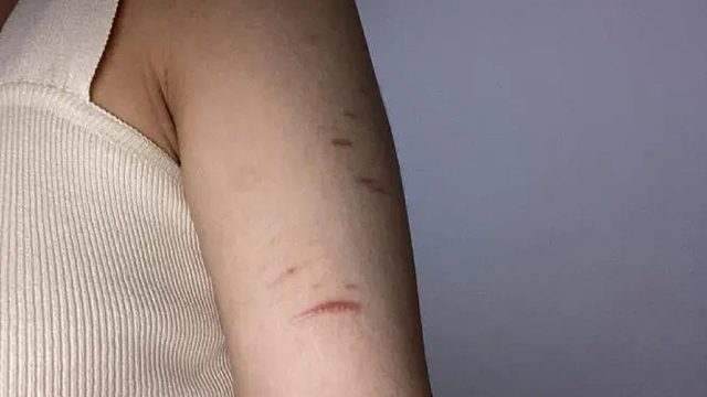 坦白局！光滑肌肤我只做了这三点！永远和疤痕say拜拜！