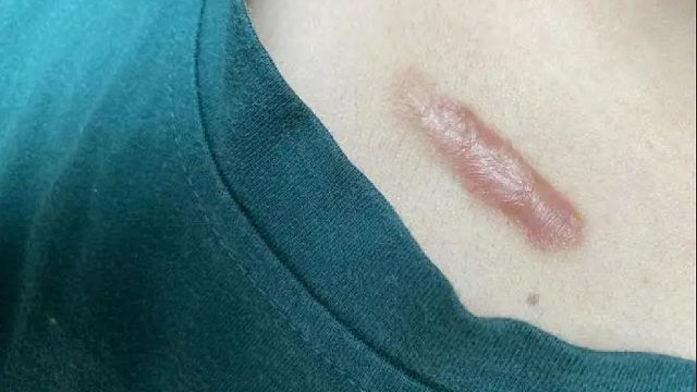 被问了800遍的祛疤秘籍！方法全在这里！一点不私藏！