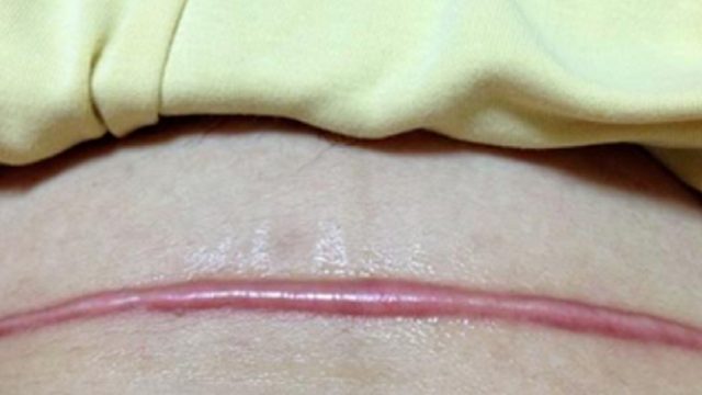 惊了！过来人只用90天成功解决增生疤痕！祛疤效果肉眼可见的好！