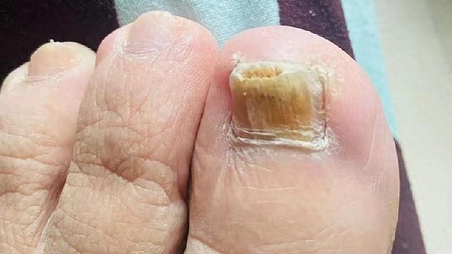 感染了灰指甲怎么办！过来人手把手教你解决！学会立省大几千！