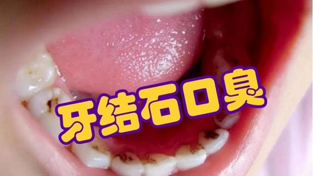 不用洗牙，不花冤枉钱！适合重度牙结石口臭的3个低成本去除方法