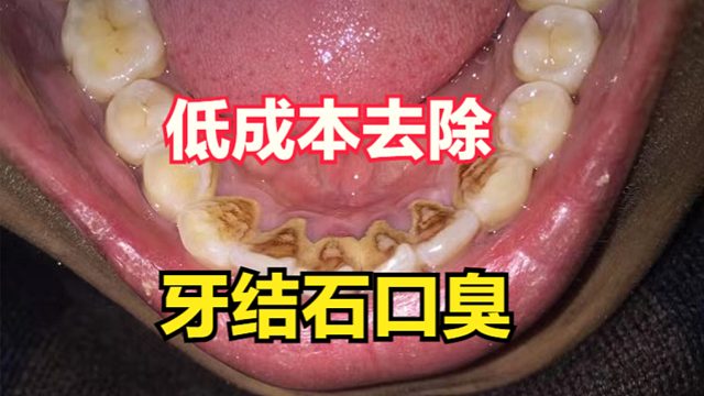 低成本去除牙结石口臭的四个关键方法，你都了解吗？