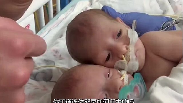 双胞胎是如何形成的？他们在肚子里“打架”，真的会打出淤青2