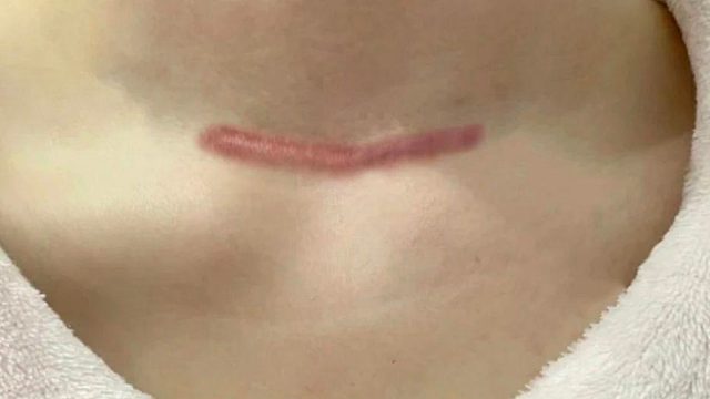 甲状腺——怎么正确有效去除疤痕 疤痕药膏如何使用？