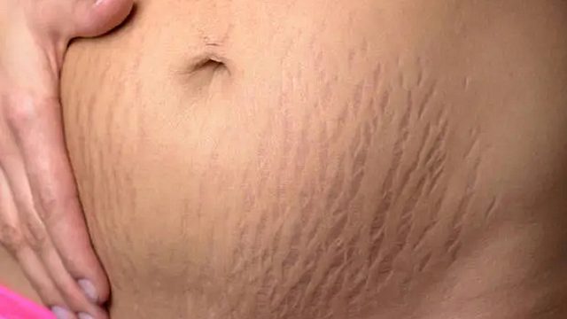 宝妈自曝妊娠纹淡化大法！简单3步，红白纹自动淡化消除！