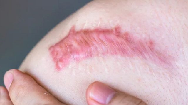 妈耶！发现了去疤痕巨牛的方法啊啊！专治疤痕太狠了！