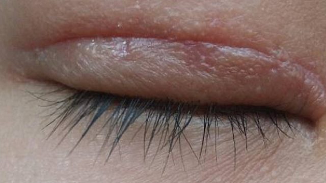 双眼皮留疤太难看？过来人真心分享！教你用芦荟胶轻松修复祛疤！