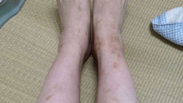 疤痕体质亲测曝光！疤痕全消就靠它们！效果又好见效又快！