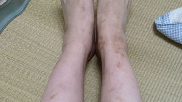 过来人亲测有效！维生素 它淡印祛疤一举两得！疤痕体质收藏码住！