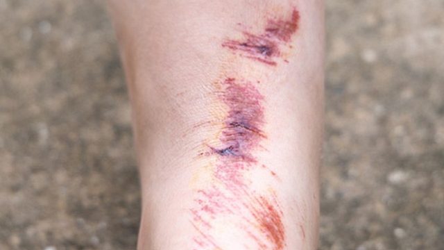 怎样对付疤痕才有效？亲测者好用物分享！彻底祛疤易如反掌！